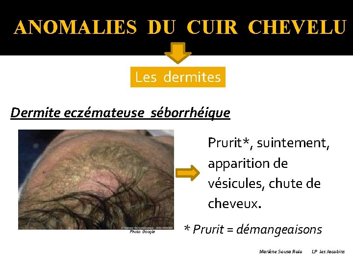 Eczéma séborrhéique ANOMALIES DU CUIR CHEVELU Les dermites Dermite eczémateuse séborrhéique Prurit*, suintement, apparition