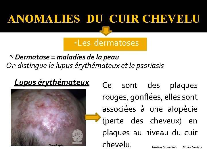 ANOMALIES DU CUIR CHEVELU � *Les dermatoses * Dermatose = maladies de la peau