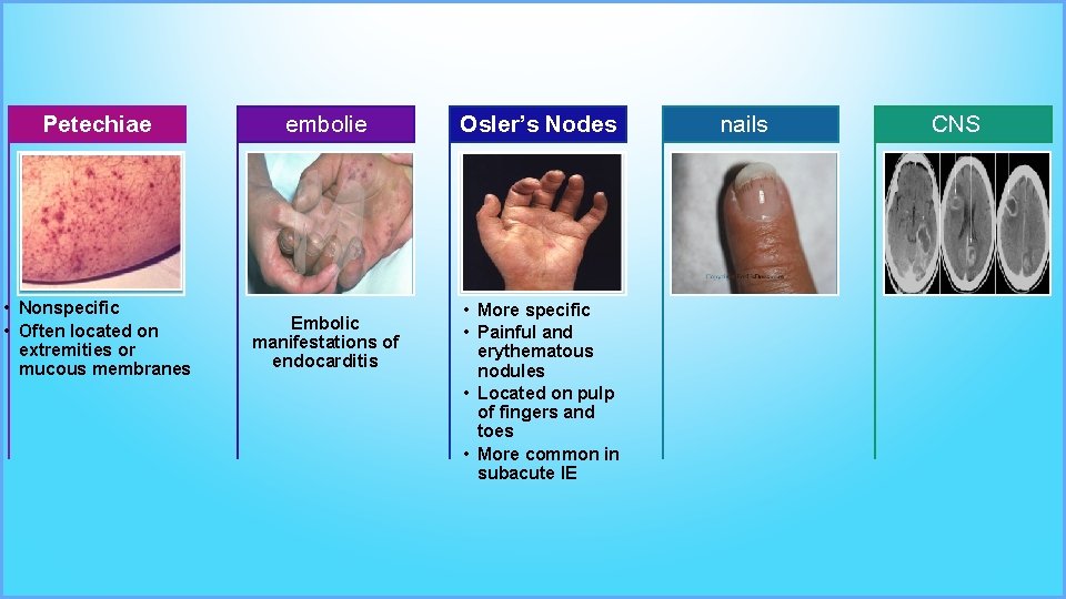 Petechiae embolie • Nonspecific • Often located on extremities or mucous membranes Embolic manifestations