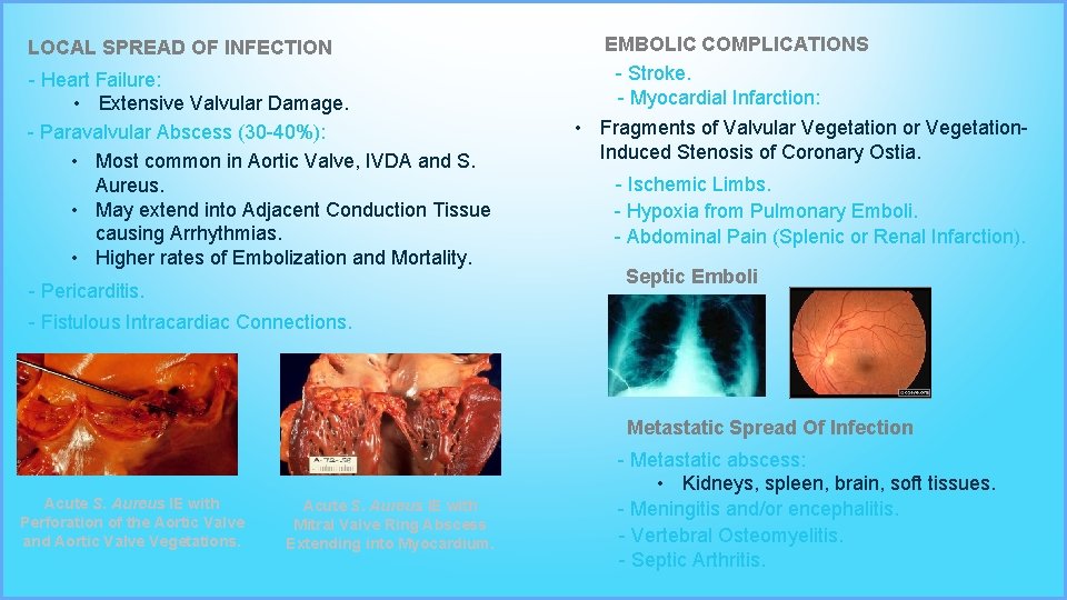 LOCAL SPREAD OF INFECTION - Heart Failure: • Extensive Valvular Damage. - Paravalvular Abscess