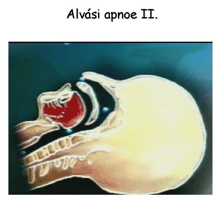 Alvási apnoe II. 