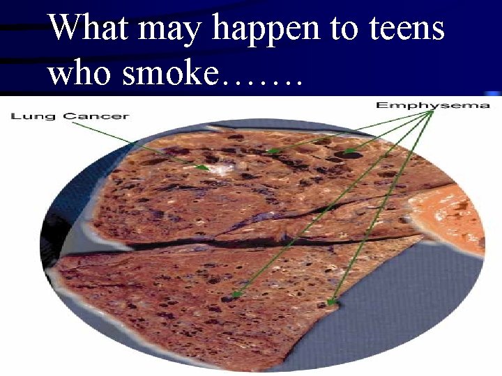 What may happen to teens who smoke……. 