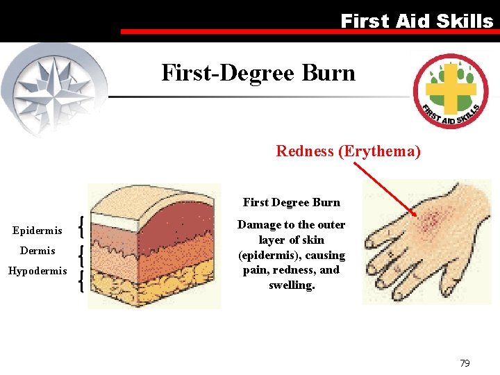First Aid Skills First-Degree Burn Redness (Erythema) First Degree Burn Epidermis Dermis Hypodermis Damage