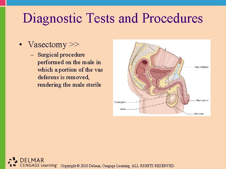 Diagnostic Tests and Procedures • Vasectomy >> – Surgical procedure performed on the male
