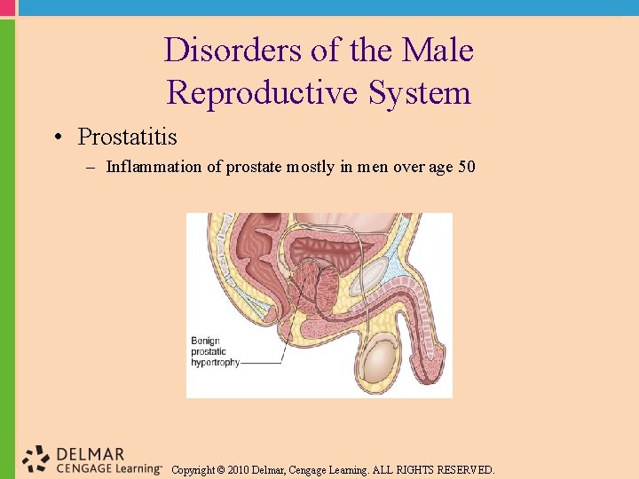 Disorders of the Male Reproductive System • Prostatitis – Inflammation of prostate mostly in