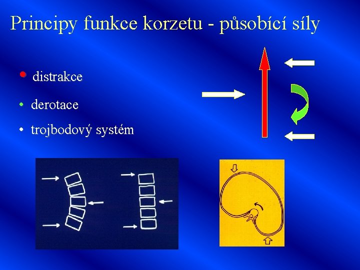 Principy funkce korzetu - působící síly • distrakce • derotace • trojbodový systém 