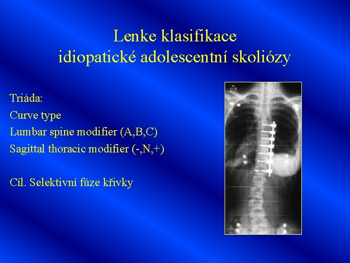 Lenke klasifikace idiopatické adolescentní skoliózy Triáda: Curve type Lumbar spine modifier (A, B, C)