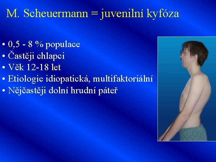 M. Scheuermann = juvenilní kyfóza • 0, 5 - 8 % populace • Častěji