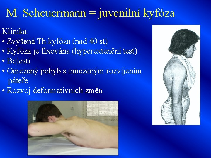 M. Scheuermann = juvenilní kyfóza Klinika: • Zvýšená Th kyfóza (nad 40 st) •