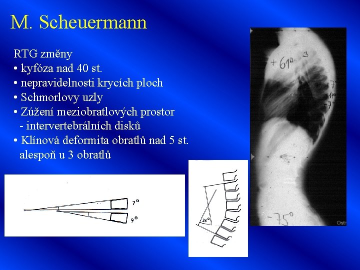 M. Scheuermann RTG změny • kyfóza nad 40 st. • nepravidelnosti krycích ploch •