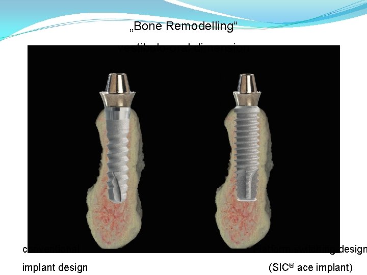 „Bone Remodelling“ vestibulo-oral dimension conventional implant design Platform switching design (SIC® ace implant) 