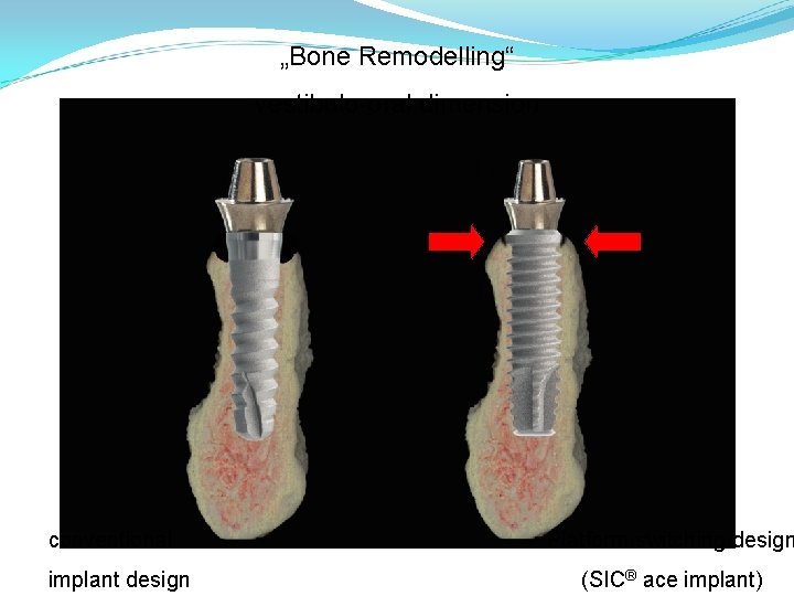 „Bone Remodelling“ vestibulo-oral dimension conventional implant design Platform switching design (SIC® ace implant) 