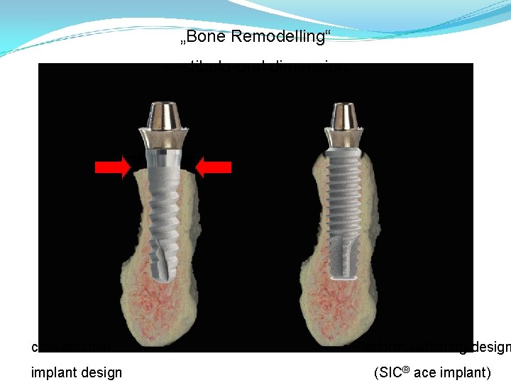 „Bone Remodelling“ vestibulo-oral dimension conventional implant design Platform switching design (SIC® ace implant) „Bone Remodelling“ vestibulo-oral dimension conventional implant design Platform switching design (SIC® ace implant)