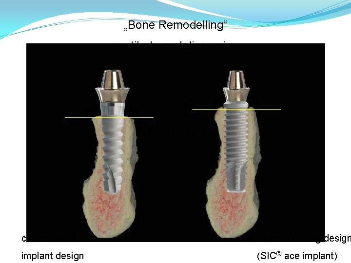 „Bone Remodelling“ vestibulo-oral dimension different bone level after remodelling conventional implant design Platform switching