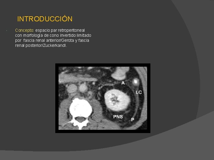INTRODUCCIÓN Concepto: espacio par retroperitoneal con morfología de cono invertido limitado por fascia renal INTRODUCCIÓN Concepto: espacio par retroperitoneal con morfología de cono invertido limitado por fascia renal