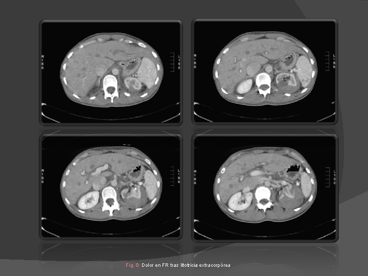 Fig. 8: Dolor en FR tras litotricia extracorpórea Fig. 8: Dolor en FR tras litotricia extracorpórea