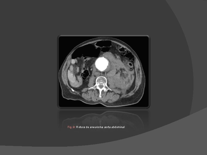 Fig. 9: Rotura de aneurisma aorta abdominal Fig. 9: Rotura de aneurisma aorta abdominal