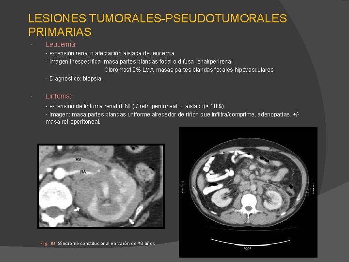 LESIONES TUMORALES-PSEUDOTUMORALES PRIMARIAS Leucemia: - extensión renal o afectación aislada de leucemia - imagen LESIONES TUMORALES-PSEUDOTUMORALES PRIMARIAS Leucemia: - extensión renal o afectación aislada de leucemia - imagen