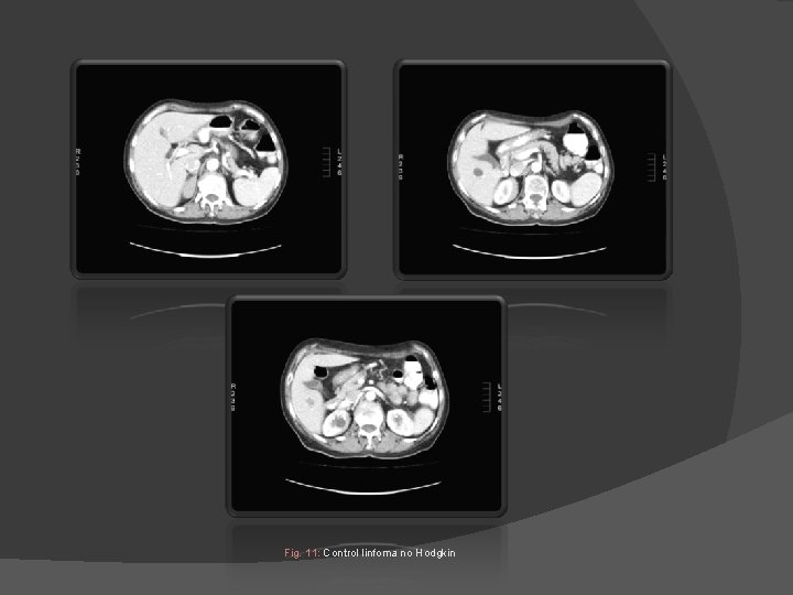 Fig. 11: Control linfoma no Hodgkin Fig. 11: Control linfoma no Hodgkin
