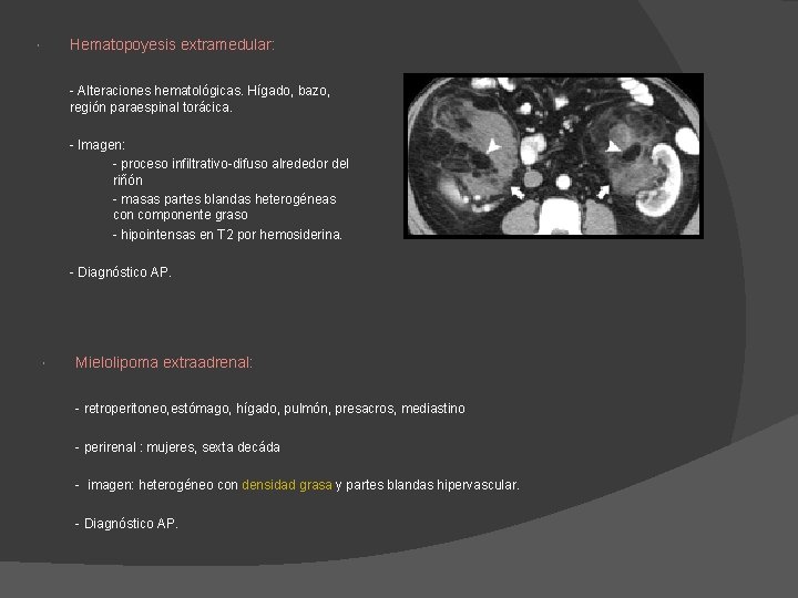 Hematopoyesis extramedular: - Alteraciones hematológicas. Hígado, bazo, región paraespinal torácica. - Imagen: - proceso Hematopoyesis extramedular: - Alteraciones hematológicas. Hígado, bazo, región paraespinal torácica. - Imagen: - proceso