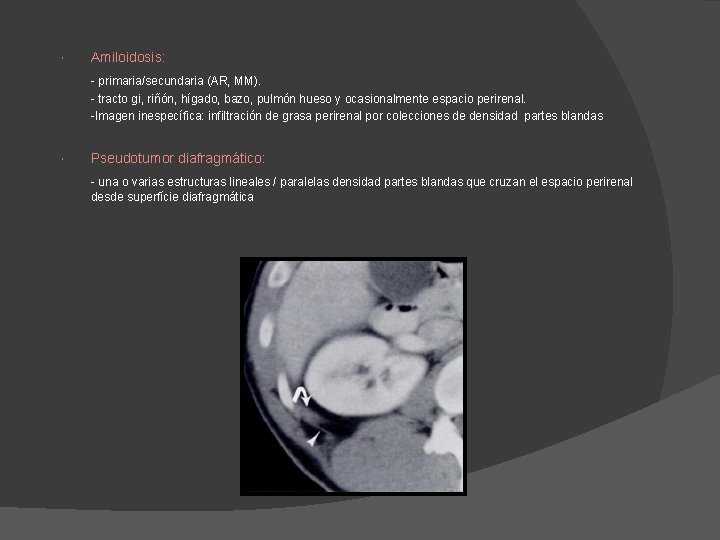 Amiloidosis: - primaria/secundaria (AR, MM). - tracto gi, riñón, hígado, bazo, pulmón hueso Amiloidosis: - primaria/secundaria (AR, MM). - tracto gi, riñón, hígado, bazo, pulmón hueso