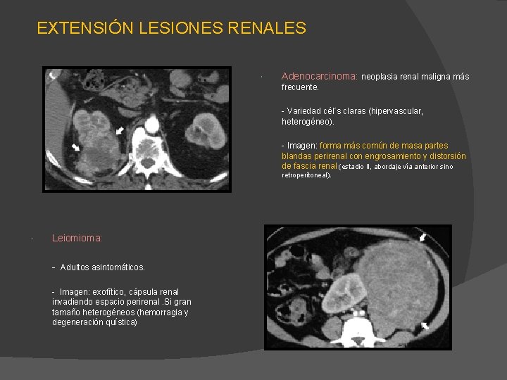 EXTENSIÓN LESIONES RENALES Adenocarcinoma: neoplasia renal maligna más frecuente. - Variedad cél´s claras (hipervascular, EXTENSIÓN LESIONES RENALES Adenocarcinoma: neoplasia renal maligna más frecuente. - Variedad cél´s claras (hipervascular,