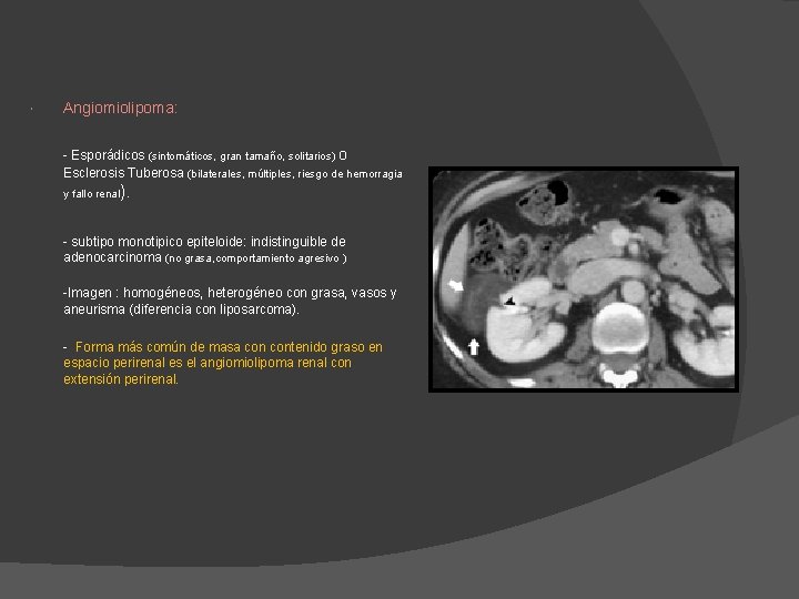 Angiomiolipoma: - Esporádicos (sintomáticos, gran tamaño, solitarios) o Esclerosis Tuberosa (bilaterales, múltiples, riesgo Angiomiolipoma: - Esporádicos (sintomáticos, gran tamaño, solitarios) o Esclerosis Tuberosa (bilaterales, múltiples, riesgo