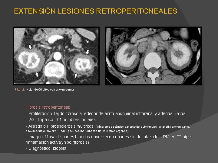 EXTENSIÓN LESIONES RETROPERITONEALES Fig. 12: Mujer de 50 años con esclerodemia Fibrosis retroperitoneal: - EXTENSIÓN LESIONES RETROPERITONEALES Fig. 12: Mujer de 50 años con esclerodemia Fibrosis retroperitoneal: -