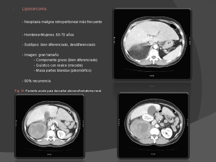 Liposarcoma: - Neoplasia maligna retroperitoneal más frecuente - Hombres=Mujeres. 60 -70 años - Liposarcoma: - Neoplasia maligna retroperitoneal más frecuente - Hombres=Mujeres. 60 -70 años -