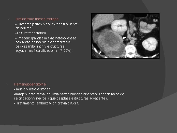 Histiocitoma fibroso maligno: - Sarcoma partes blandas más frecuente en adultos. -15% retroperitoneo. Histiocitoma fibroso maligno: - Sarcoma partes blandas más frecuente en adultos. -15% retroperitoneo.