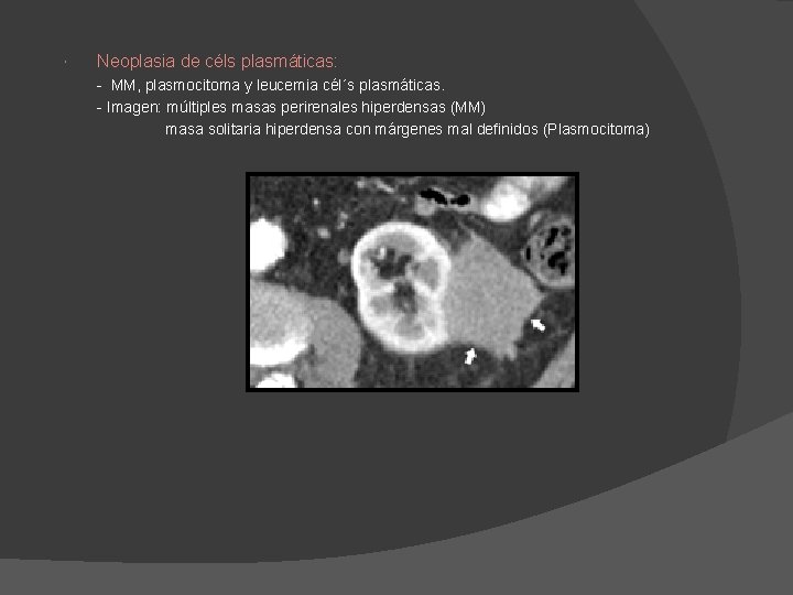 Neoplasia de céls plasmáticas: - MM, plasmocitoma y leucemia cél´s plasmáticas. - Imagen: Neoplasia de céls plasmáticas: - MM, plasmocitoma y leucemia cél´s plasmáticas. - Imagen: