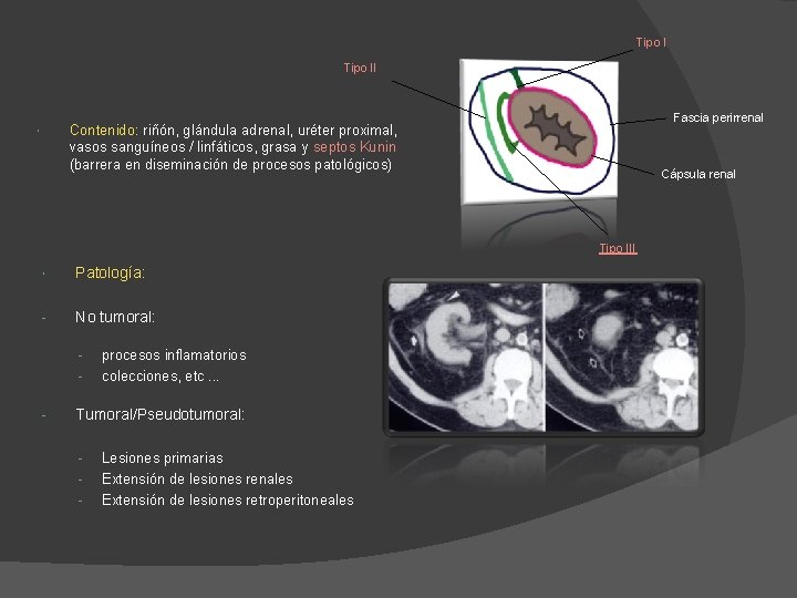 Tipo II Fascia perirrenal Contenido: riñón, glándula adrenal, uréter proximal, vasos sanguíneos / linfáticos, Tipo II Fascia perirrenal Contenido: riñón, glándula adrenal, uréter proximal, vasos sanguíneos / linfáticos,