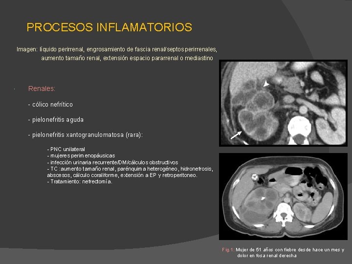 PROCESOS INFLAMATORIOS Imagen: líquido perirrenal, engrosamiento de fascia renal/septos perirrenales, aumento tamaño renal, extensión PROCESOS INFLAMATORIOS Imagen: líquido perirrenal, engrosamiento de fascia renal/septos perirrenales, aumento tamaño renal, extensión
