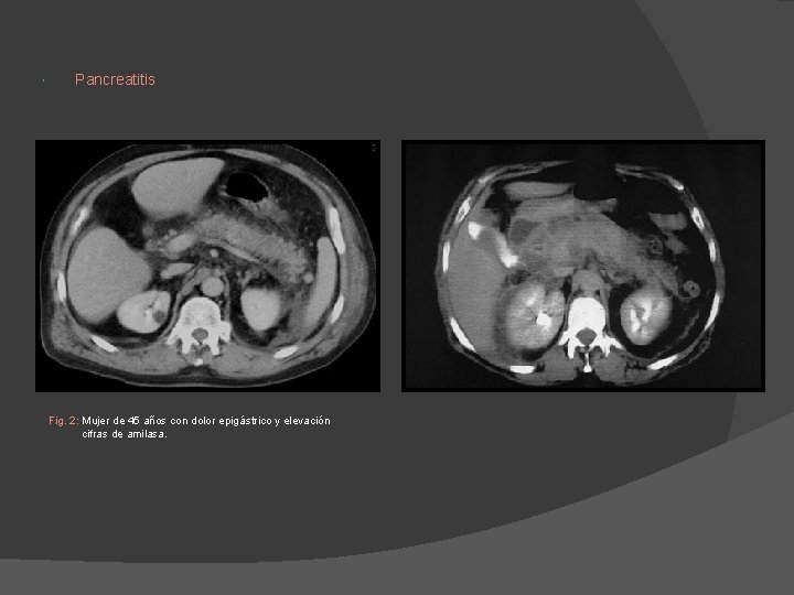 Pancreatitis Fig. 2: Mujer de 45 años con dolor epigástrico y elevación cifras Pancreatitis Fig. 2: Mujer de 45 años con dolor epigástrico y elevación cifras