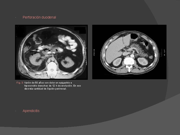 Perforación duodenal Fig. 3: Varón de 50 años con dolor en epigastrio e Perforación duodenal Fig. 3: Varón de 50 años con dolor en epigastrio e