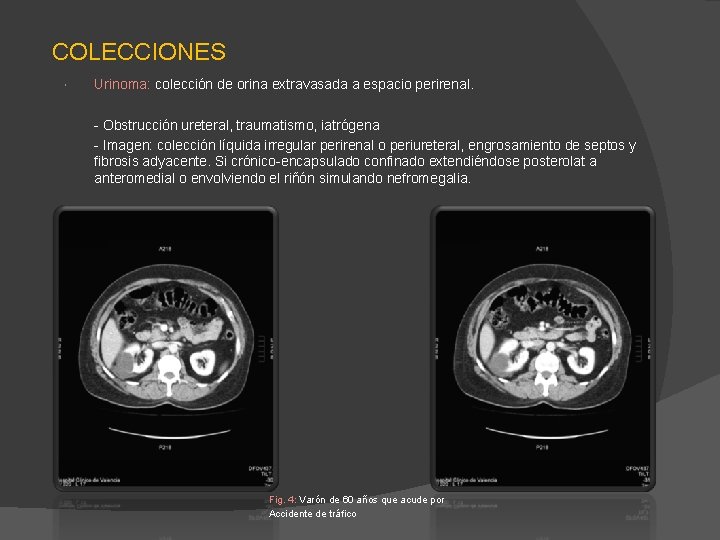 COLECCIONES Urinoma: colección de orina extravasada a espacio perirenal. - Obstrucción ureteral, traumatismo, iatrógena COLECCIONES Urinoma: colección de orina extravasada a espacio perirenal. - Obstrucción ureteral, traumatismo, iatrógena
