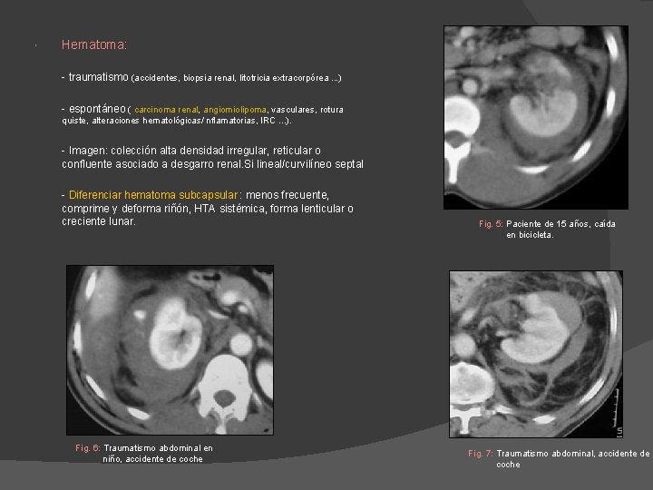 Hematoma: - traumatismo (accidentes, biopsia renal, litotricia extracorpórea. . . ) - espontáneo Hematoma: - traumatismo (accidentes, biopsia renal, litotricia extracorpórea. . . ) - espontáneo