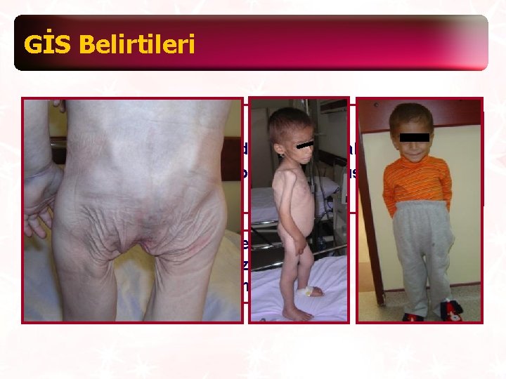 GİS Belirtileri Malabsorbsiyon belirtileri Kronik-aralıklı ishal, yağlı dışkılama, iştahsızlık, karında şişlik, aşırı gaz, kusma,