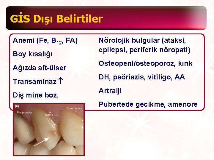 GİS Dışı Belirtiler Anemi (Fe, B 12, FA) Boy kısalığı Ağızda aft-ülser Transaminaz Diş