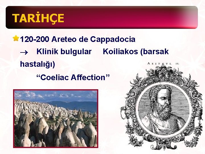 TARİHÇE 120 -200 Areteo de Cappadocia ® Klinik bulgular Koiliakos (barsak hastalığı) “Coeliac Affection”