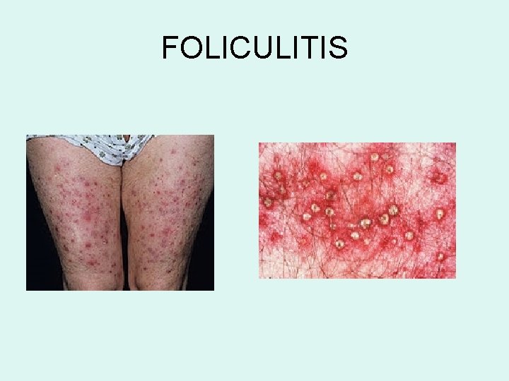 FOLICULITIS FOLICULITIS