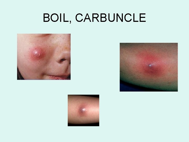 BOIL, CARBUNCLE BOIL, CARBUNCLE