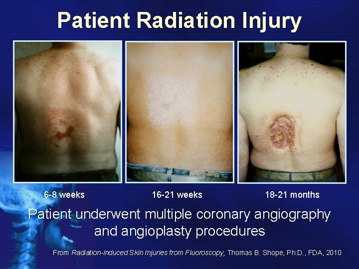 Patient Radiation Injury 6 -8 weeks 16 -21 weeks 18 -21 months Patient underwent