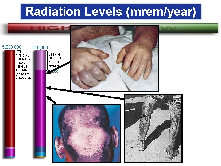 Radiation Levels (mrem/year) 5, 000 500, 000 TYPICAL THERAPY X-RAY TO SINGLE ORGAN (series