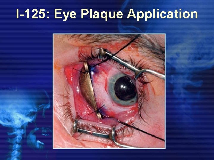 I-125: Eye Plaque Application 