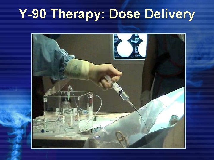 Y-90 Therapy: Dose Delivery 