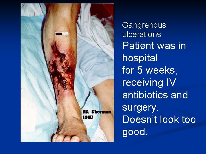 Gangrenous ulcerations Patient was in hospital for 5 weeks, receiving IV antibiotics and surgery. Gangrenous ulcerations Patient was in hospital for 5 weeks, receiving IV antibiotics and surgery.