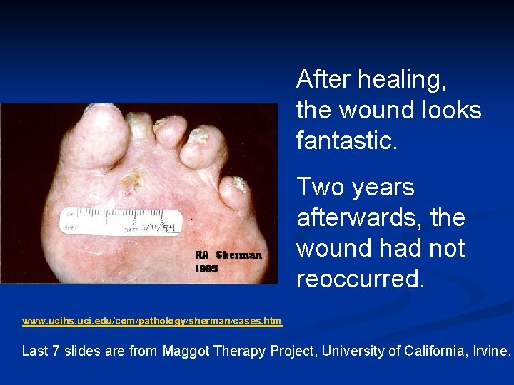 After healing, the wound looks fantastic. Two years afterwards, the wound had not reoccurred. After healing, the wound looks fantastic. Two years afterwards, the wound had not reoccurred.
