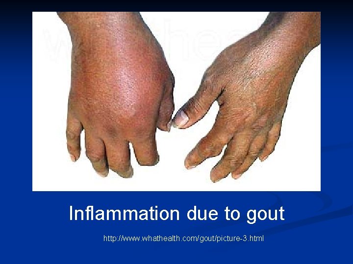 Inflammation due to gout http: //www. whathealth. com/gout/picture-3. html Inflammation due to gout http: //www. whathealth. com/gout/picture-3. html