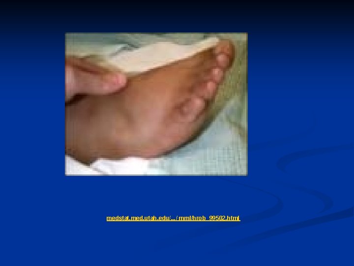 medstat. med. utah. edu/. . . / mml/hrob_99502. html medstat. med. utah. edu/. . . / mml/hrob_99502. html